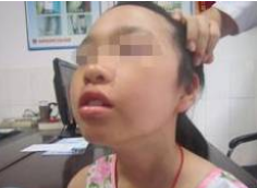 白癜风是由什么引起的
